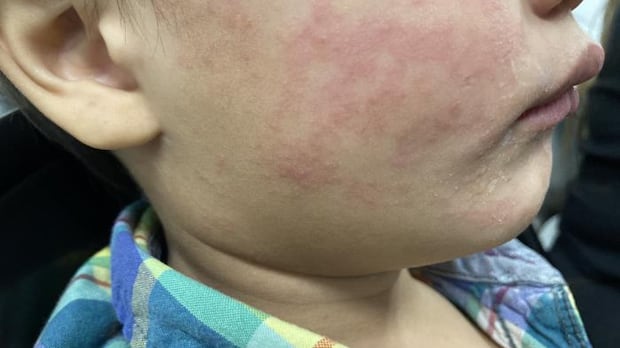 Manitoba parents and guardians received a warning from public health officials ahead of spring break vacations and Easter holidays asking them to consider measles risks while travelling or attending large gatherings.